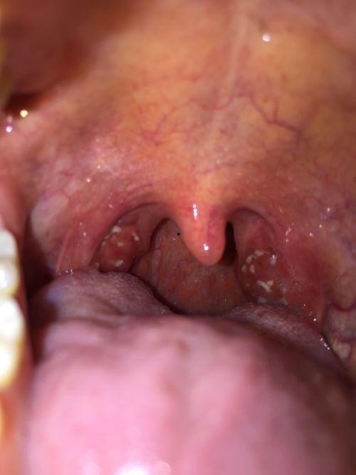 吃小瓜后喉咙痒,揭秘原因及应对策略